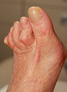  artrose oudere voet- dig IV clavus 4581